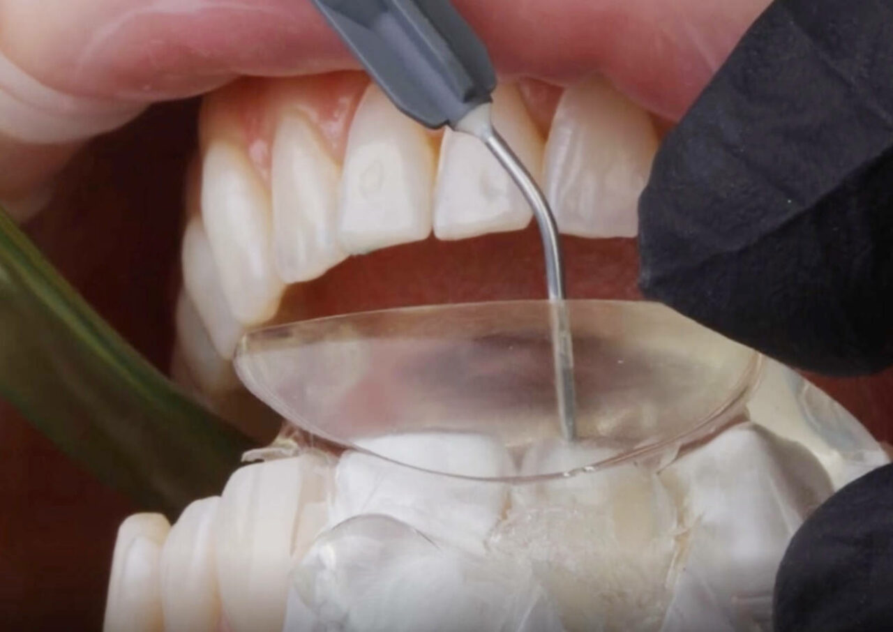 Composite Bonding Dodder Park Dental Dentist Dublin