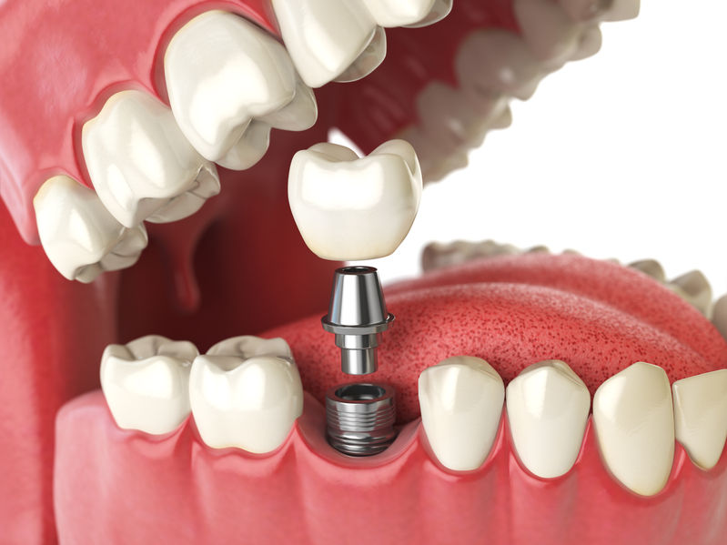 Dental Implants Dublin