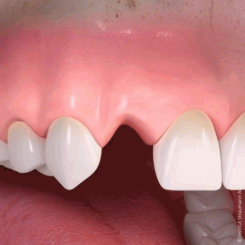 Tooth implant Dublin