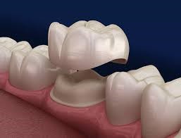 Prosthodontics - Zirconia Crowns