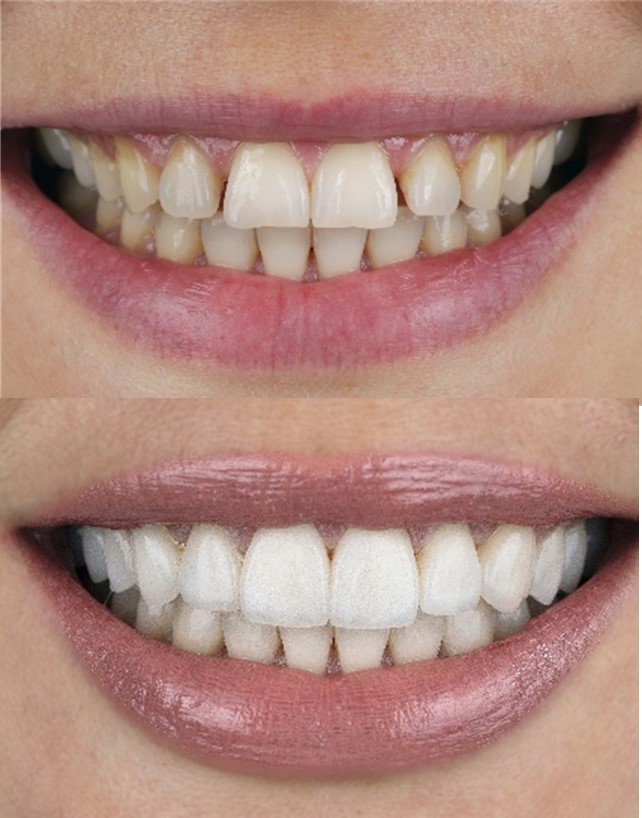 Veneers Dublin Terenure Rathfarnham